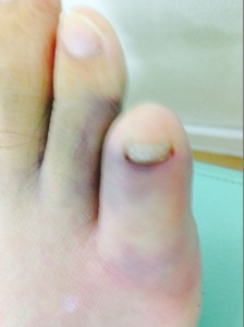 足の指の骨折