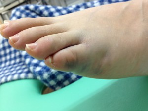 小指の基節骨骨折