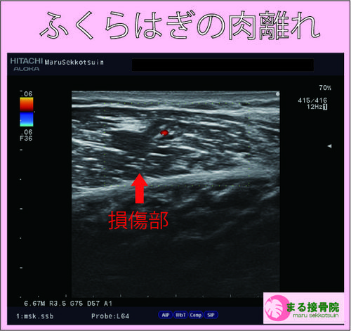 ふくらはぎの肉離れ　エコー画像.jpg