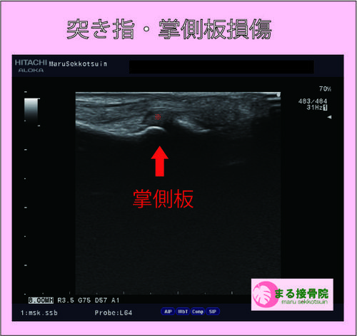 突き指・掌側板損傷.jpg
