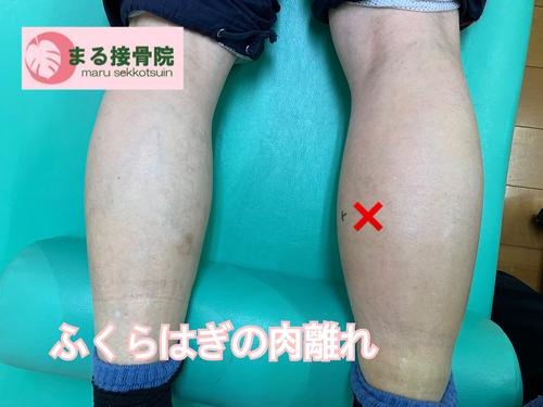 腓腹筋肉離れ1.JPG