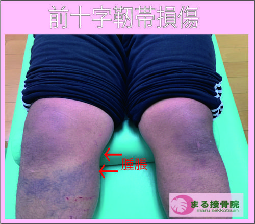 前十字靭帯損傷.jpg