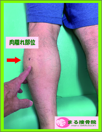 腓腹筋の肉ばなれ.jpg