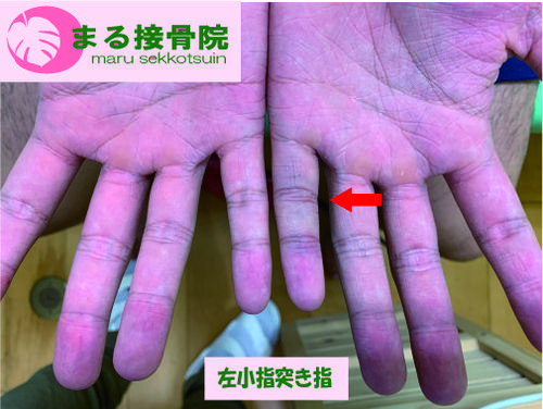 小指突き指.jpg