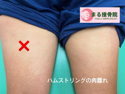 ハムストリングスの肉離れ.JPG