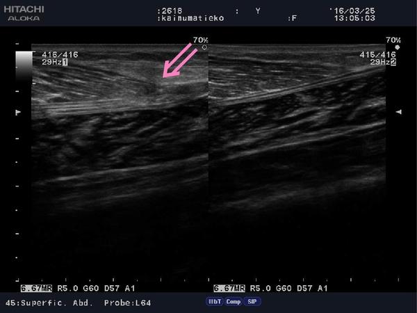 Calf muscle strain.jpg