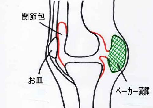 ベーカー嚢腫1.jpg