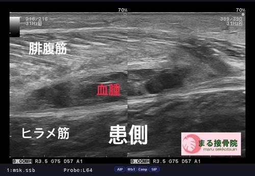腓腹筋肉離れエコー.JPG