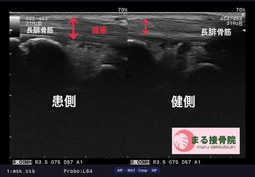 長腓骨筋腱炎　エコー.JPG