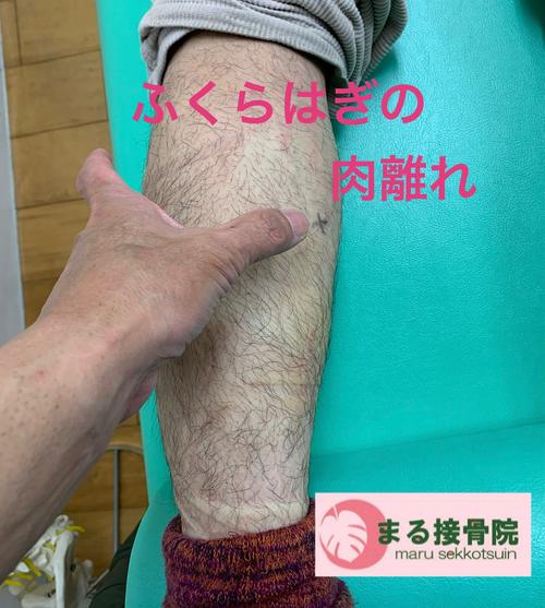 ふくらはぎの肉離れ.jpg
