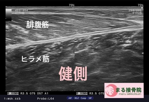 ふくらはぎ肉離れエコー1.JPG