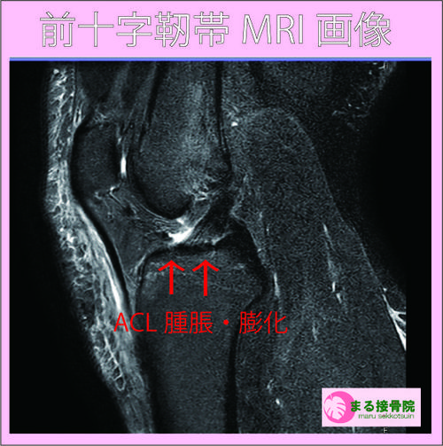 ACL損傷.jpg