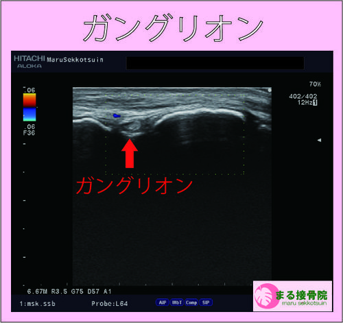 ガングリオン　エコー画像.jpg