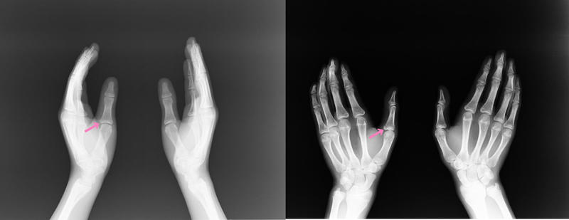親指の付け根の骨折 基節骨骨折 更新情報 まる接骨院