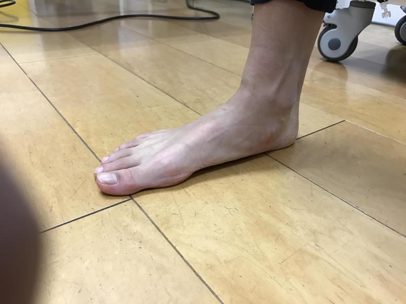 Flat feet.jpg