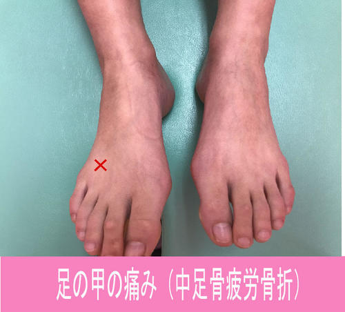 足の甲の痛み.jpg