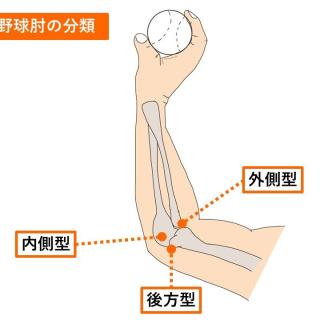 人気沸騰ブラドン 野球肘」「テニス肘」「ゴルフ肘」> 更新情報 まる接骨院 その他