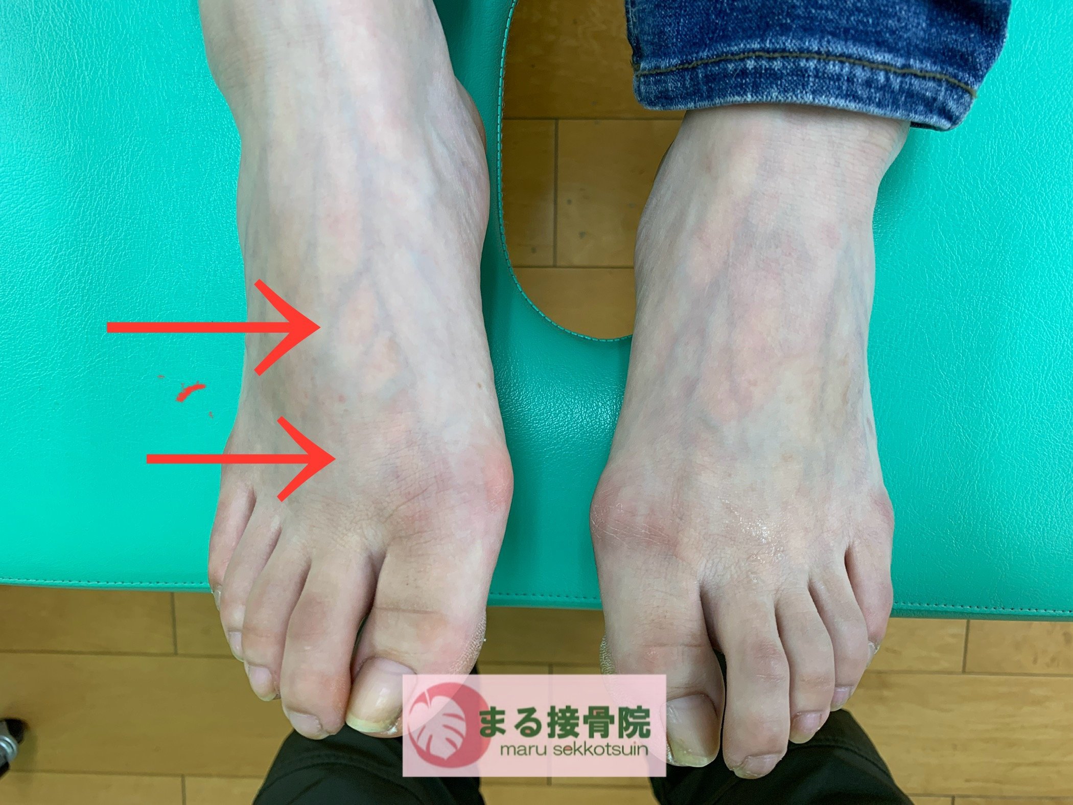 足の甲の腫れ・痛み