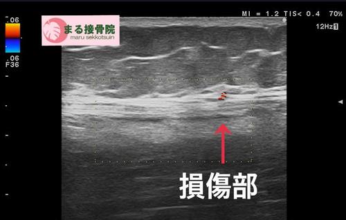 ハムストリングスの肉離れエコー画像.JPG