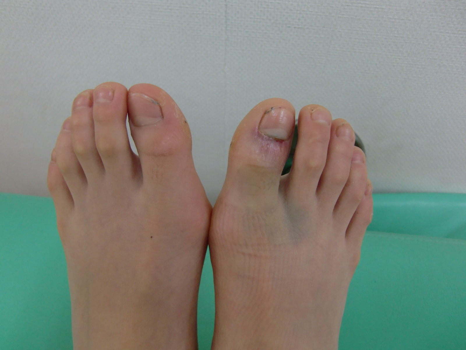 足 の 指 骨折 自然 治癒