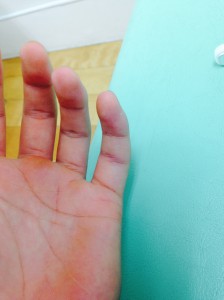 小指の骨折