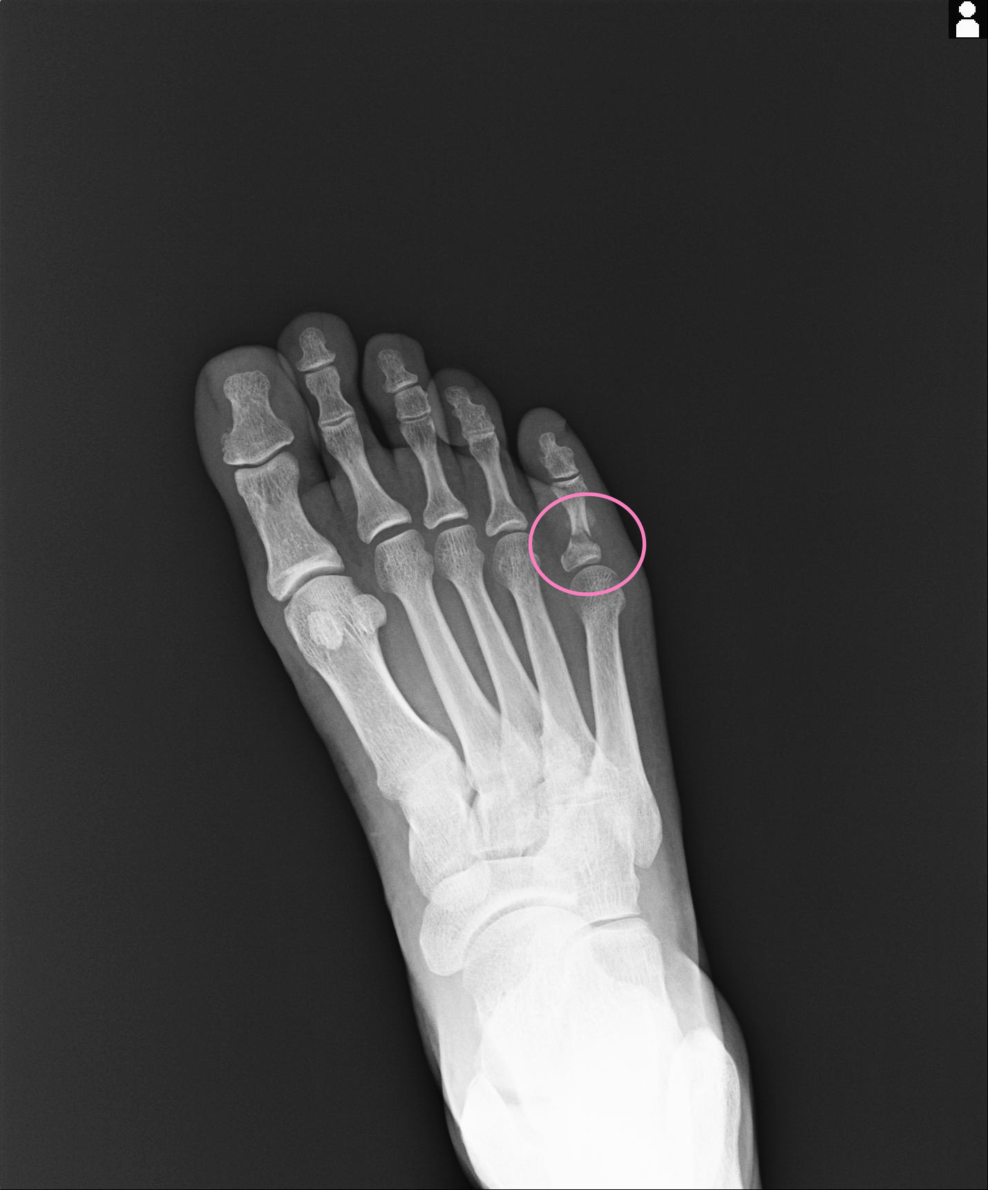 足の小指骨折