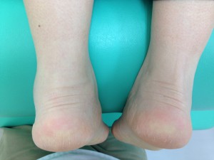 足首の捻挫腫れ (1)
