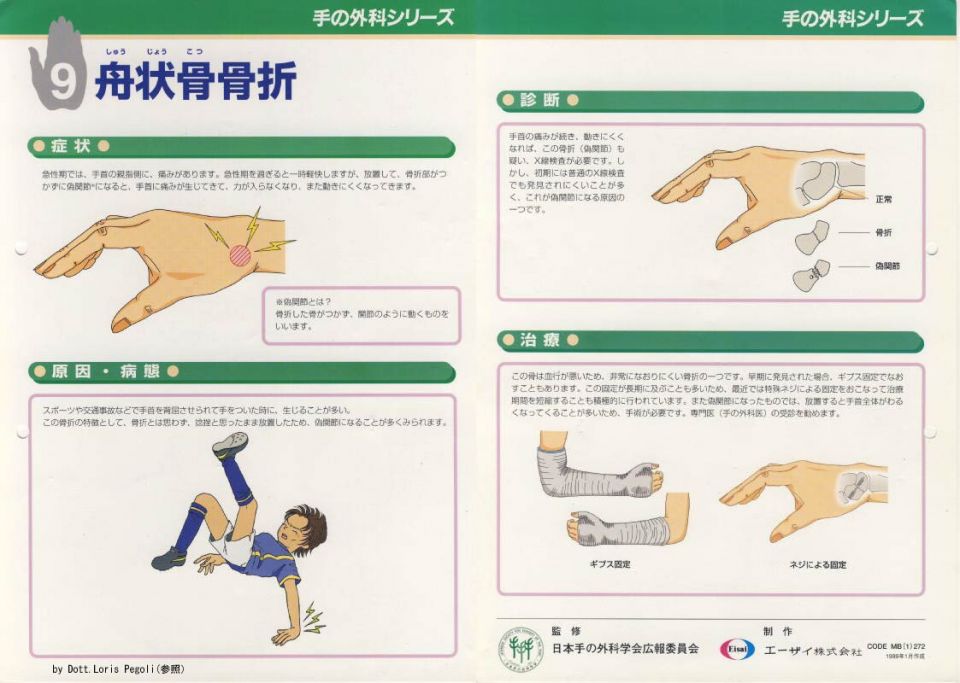 手の舟状骨骨折 更新情報 まる接骨院